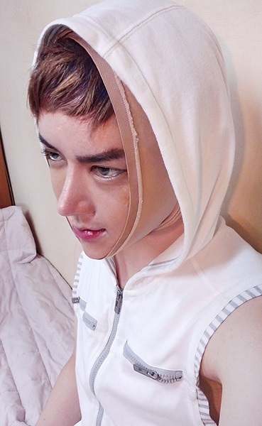 Korean boy before and after surgery