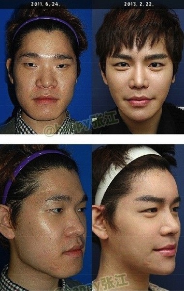 Korean boy before and after surgery