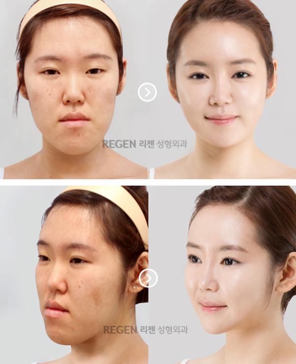 Plastic surgery in korea