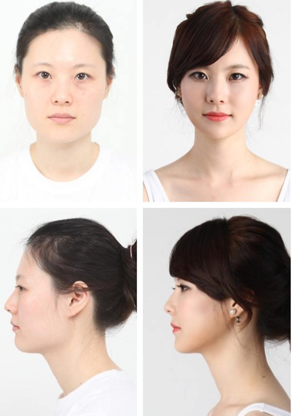 Plastic surgery in korea