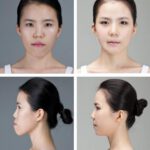 plastic-surgery-in-korea-3.jpg
