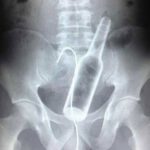 man-swallowed-a-bottle.jpg