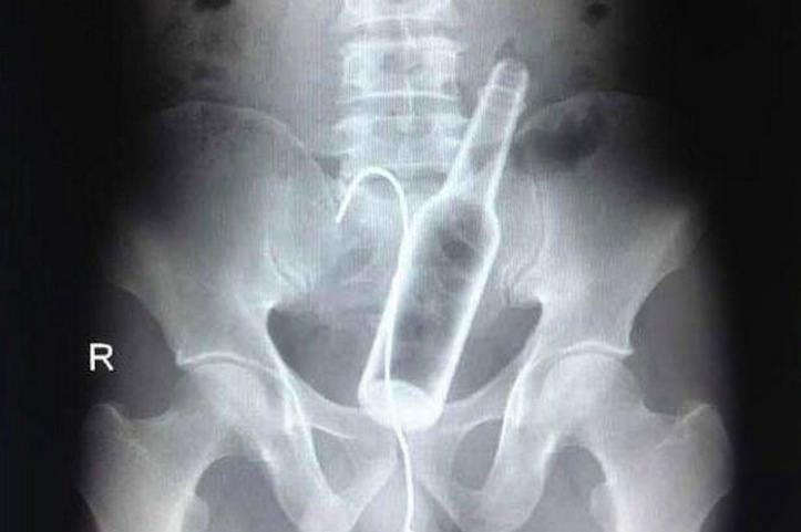 Man swallowed a bottle