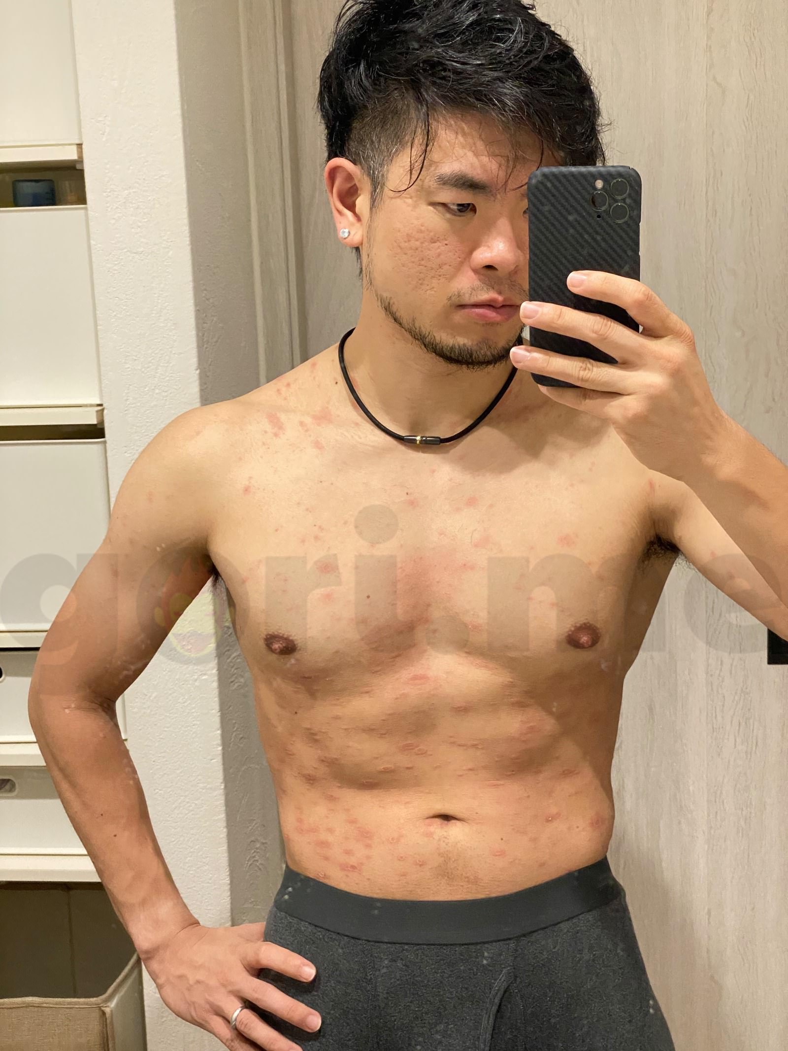 tyriasis-rosea-Gibert-Disease-04