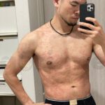 tyriasis-rosea-Gibert-Disease-05