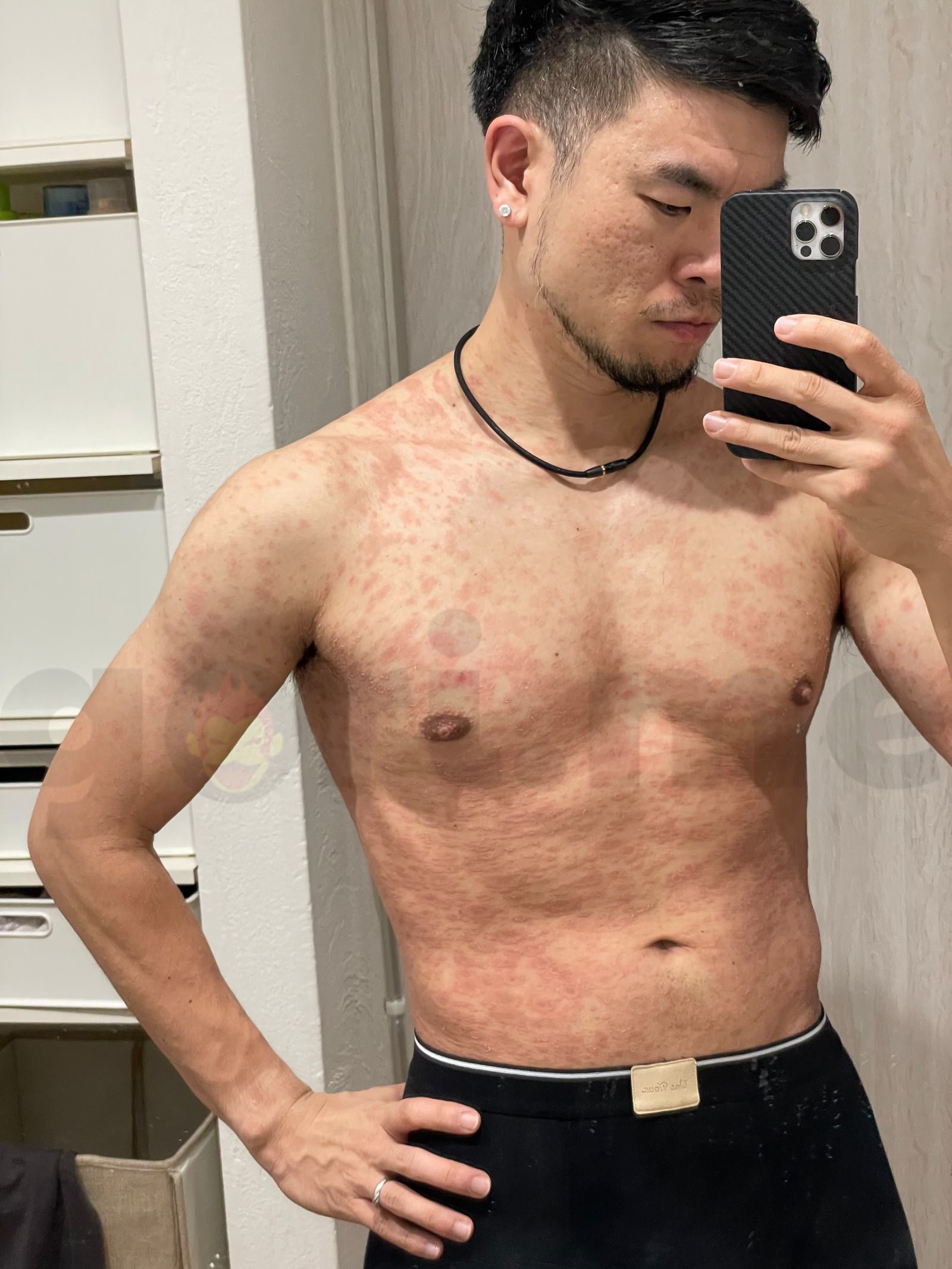 tyriasis-rosea-Gibert-Disease-05