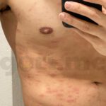 tyriasis-rosea-Gibert-Disease-06