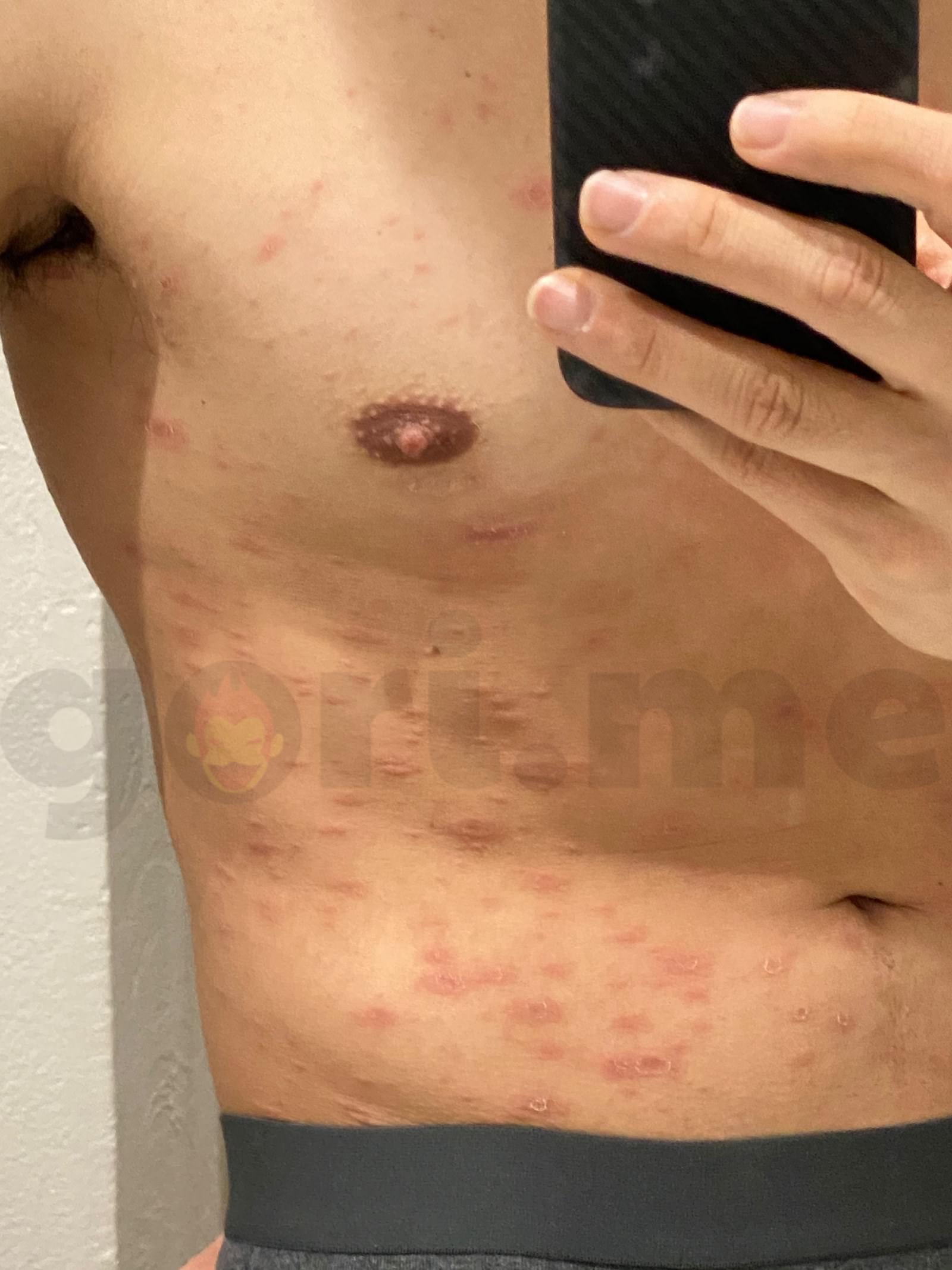 tyriasis-rosea-Gibert-Disease-06