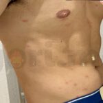 tyriasis-rosea-Gibert-Disease-07