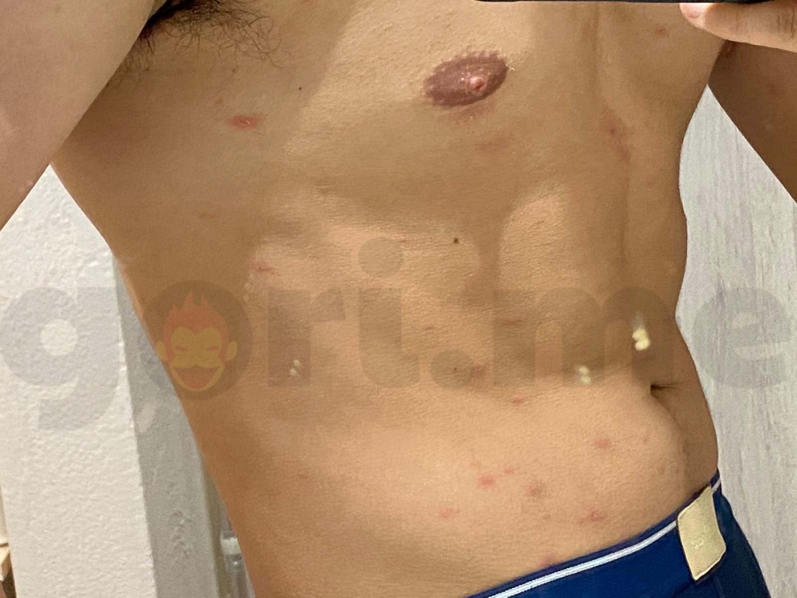 tyriasis-rosea-Gibert-Disease-07