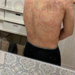 tyriasis-rosea-Gibert-Disease-08