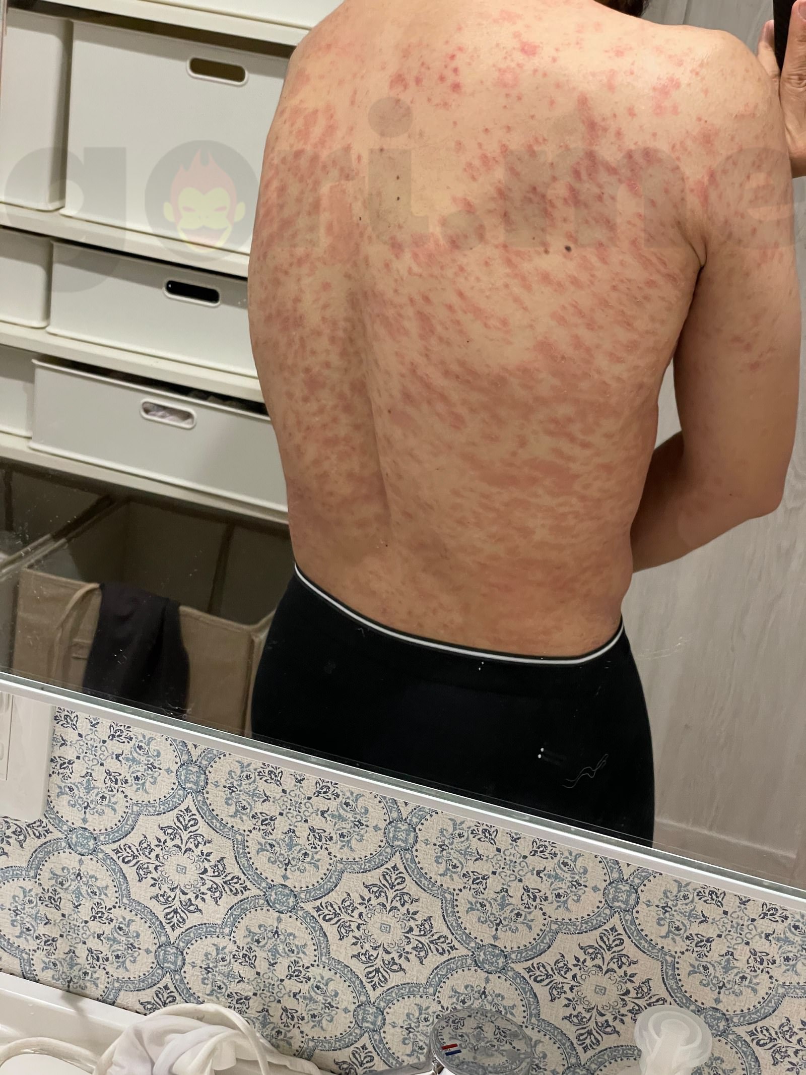 tyriasis-rosea-Gibert-Disease-08